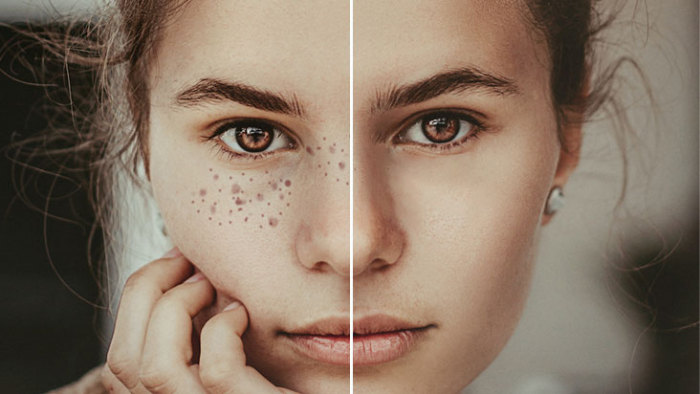 Skin Retouching & Freckle Removal